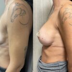 Mastoplastica mininvasiva a Seregno – Monza