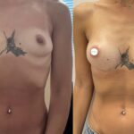 Mastoplastica mininvasiva a Seregno – Monza