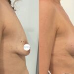 Mastoplastica mininvasiva a Seregno – Monza