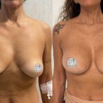 Mastoplastica mininvasiva a Seregno – Monza