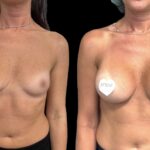 Mastoplastica mininvasiva a Seregno – Monza