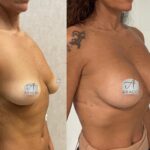 Mastoplastica mininvasiva a Seregno – Monza