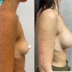 Mastoplastica mininvasiva a Seregno – Monza