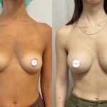 Mastoplastica mininvasiva a Seregno – Monza