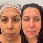 Trattamento delle macchie del volto