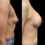 Mastoplastica mininvasiva a Seregno – Monza