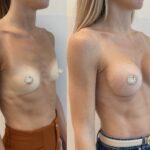 Mastoplastica mininvasiva a Seregno – Monza