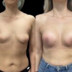 Mastoplastica mininvasiva a Seregno – Monza