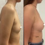 Mastoplastica mininvasiva a Seregno – Monza