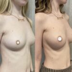 Mastoplastica mininvasiva a Seregno – Monza