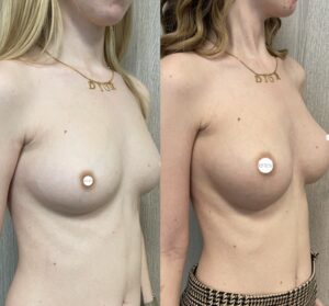 Mastoplastica mininvasiva a Seregno - Monza