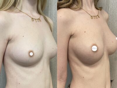 Mastoplastica mininvasiva a Seregno - Monza