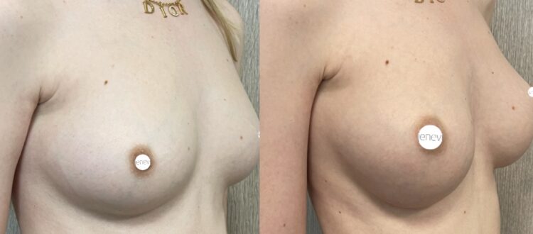 Mastoplastica mininvasiva a Seregno - Monza