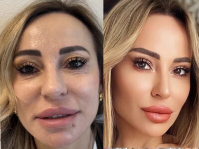 Plasma Piastrine volto – Elisir di giovinezza