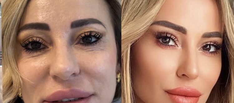 Plasma Piastrine volto – Elisir di giovinezza