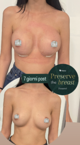 Mastoplastica Preserv&egrave; Motiva a Seregno - Monza