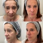 Tossina Botulinica a Lugano nel centro Jenevì Medical