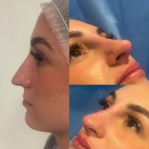 Filler Acido Ialuronico a Lugano nel centro Jenev&igrave; Medical