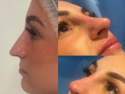 Filler Acido Ialuronico a Lugano nel centro Jenevì Medical