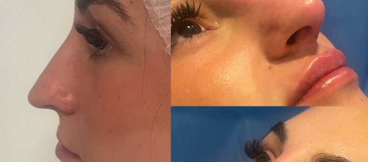 Filler Acido Ialuronico a Lugano nel centro Jenevì Medical